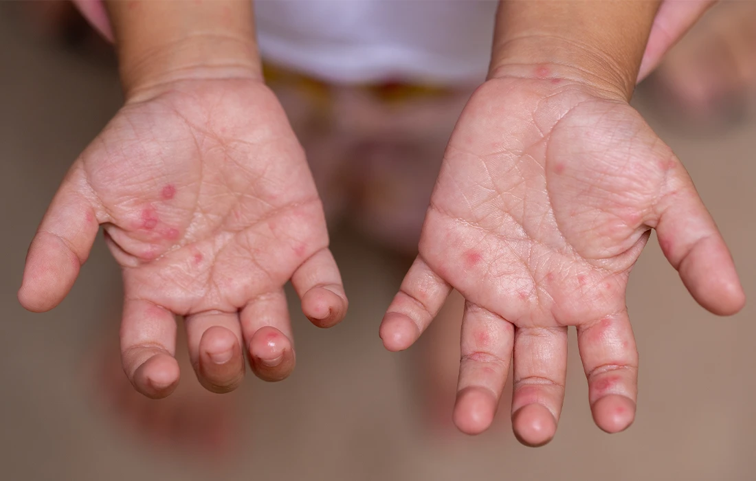 Otwarte dłonie dziecka z czerwonymi plamami i wysypką na dłoniach i palcach, wskazujące na możliwą infekcję lub chorobę skóry.